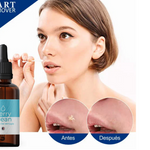 Elimina Verrugas con Verryclean